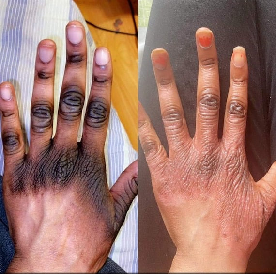 Original Clear All Dark Knuckle and Dark Spot